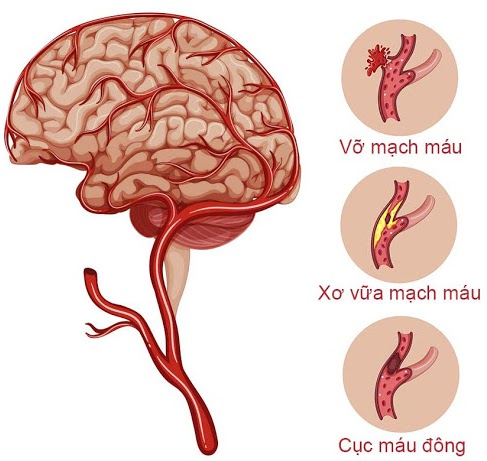 Tai biến mạch máu não