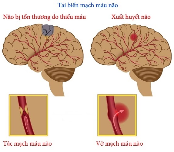 Cơ chế tai biến mạch máu não