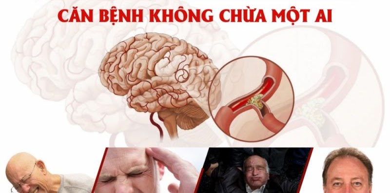 Nguy cơ đột quỵ