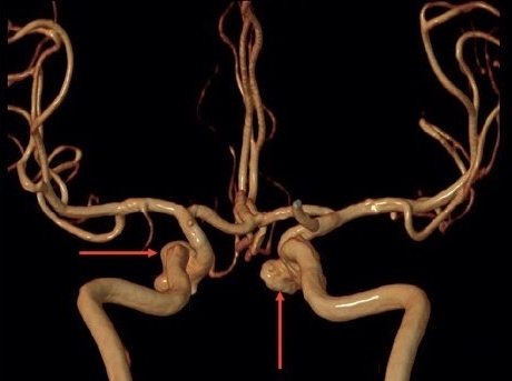 Chụp cộng hưởng từ mạch máu não
