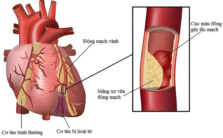 Huyết khối gây tắc động mạch vành