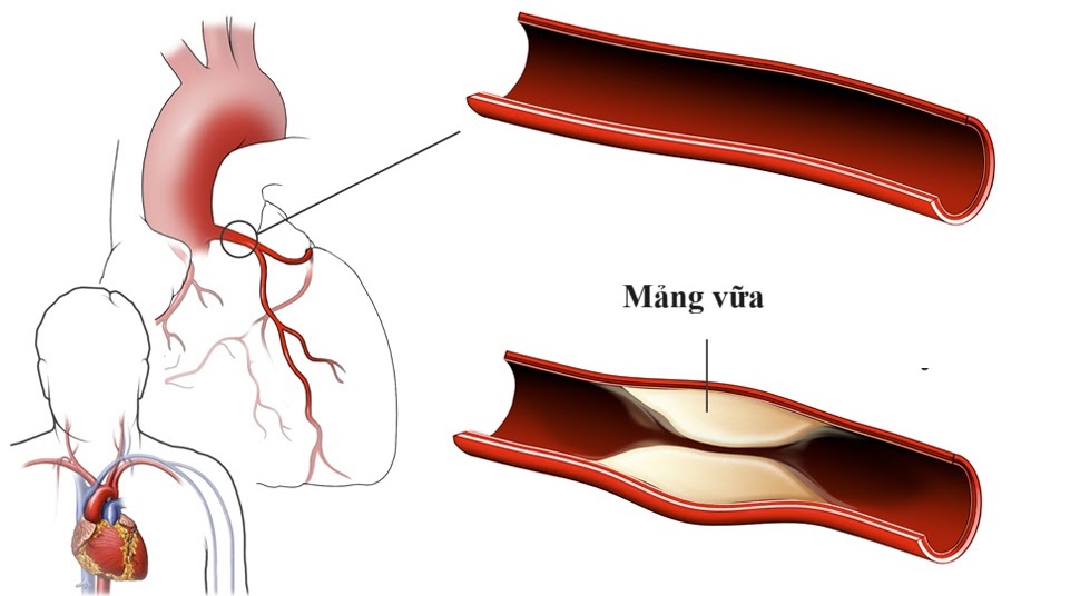 Thiếu máu cơ tim