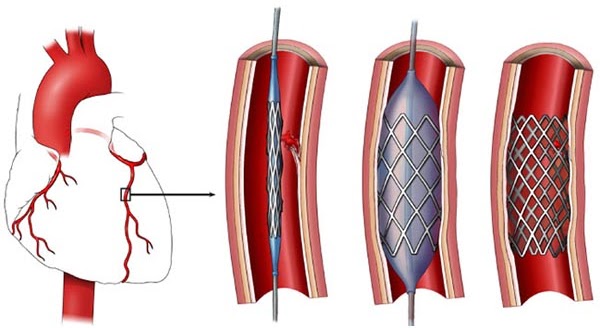 Yếu tố nguy cơ tim mạch